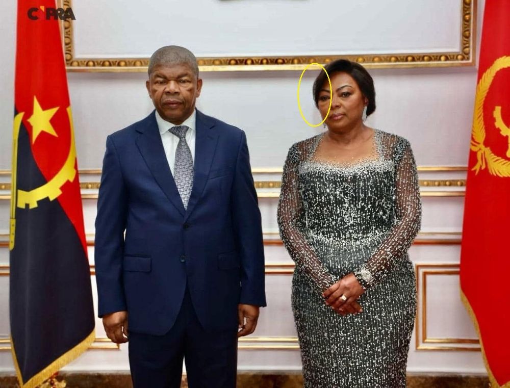 APARIÇÃO DA PRIMEIRA-DAMA DA REPÚBLICA COM HEMATOMAS GERA POLÉMICA